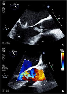 Multimodality Evaluation of Aortic Insufficiency and Aortitis in Rheumatologic Diseases